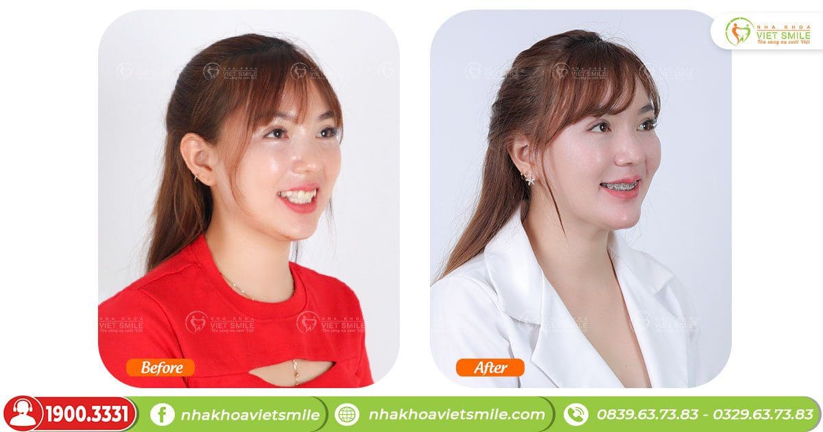 Góc nghiêng thay đổi sau 1,5 năm niềng răng