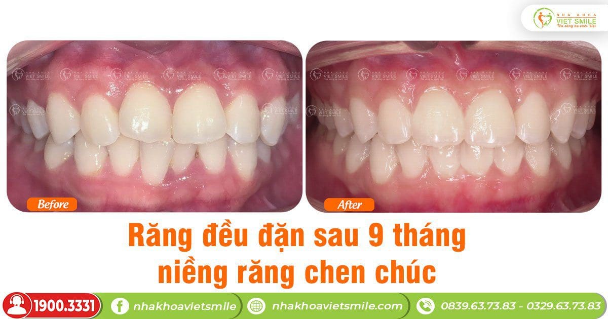 Răng đều đặn sau 9 tháng niềng răng
