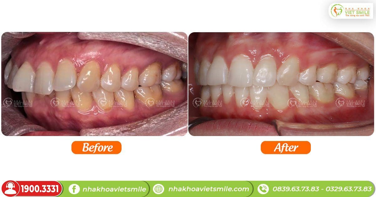 Trước và sau khi niềng răng