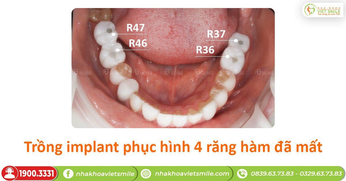 Trồng implant phục hình 4 răng hàm đã mất
