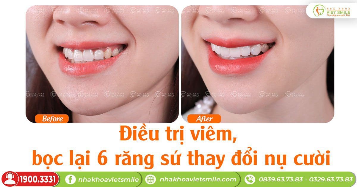 Điều trị viêm, bọc lại 6 răng sứ thay đổi nụ cười