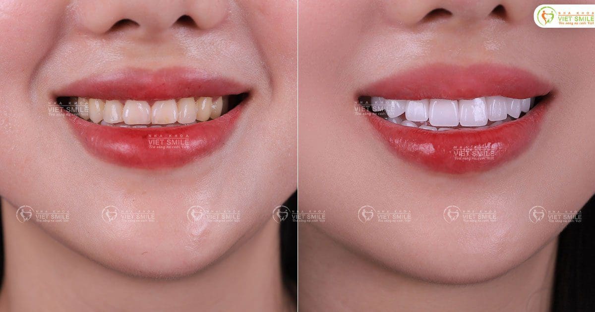 Bọc răng sứ Lava Plus thủ công khắc phục răng xỉn màu