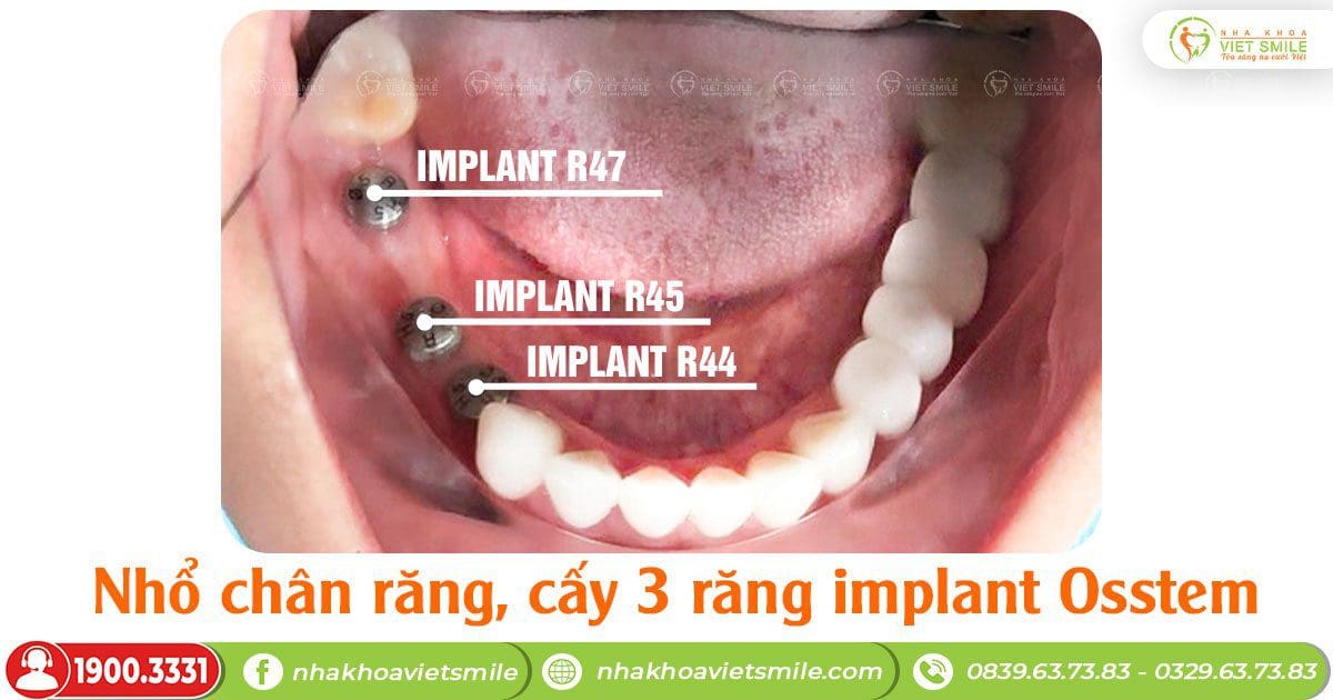 Cấy ghép implant 3 răng hàm