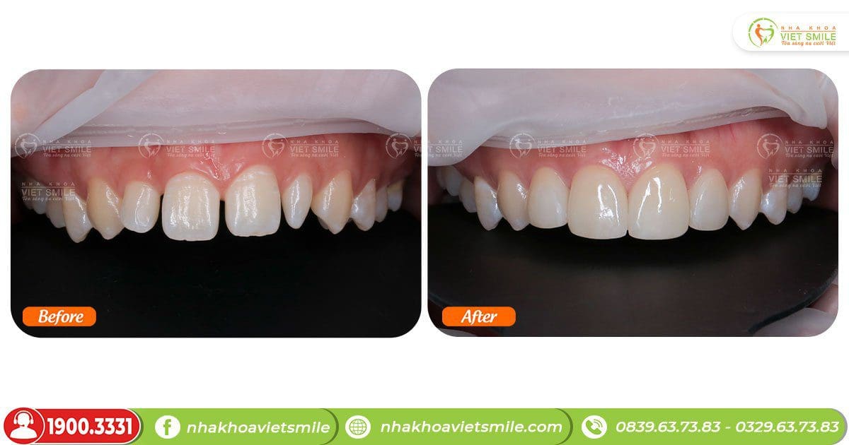 Trước và sau dán sứ 4 răng cửa - Góc nghiêng