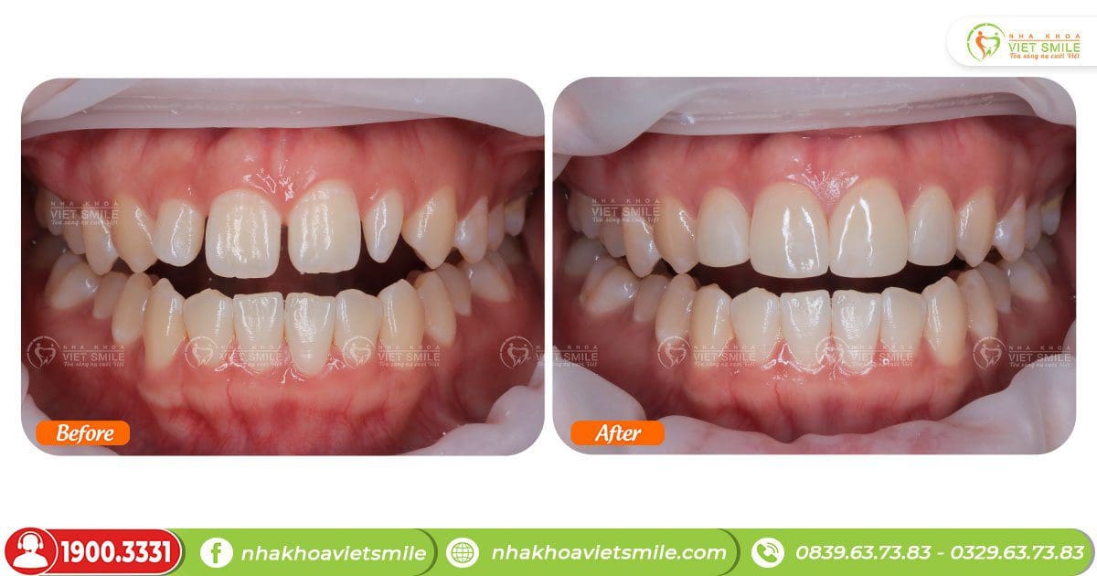 Trước và sau dán sứ 4 răng cửa