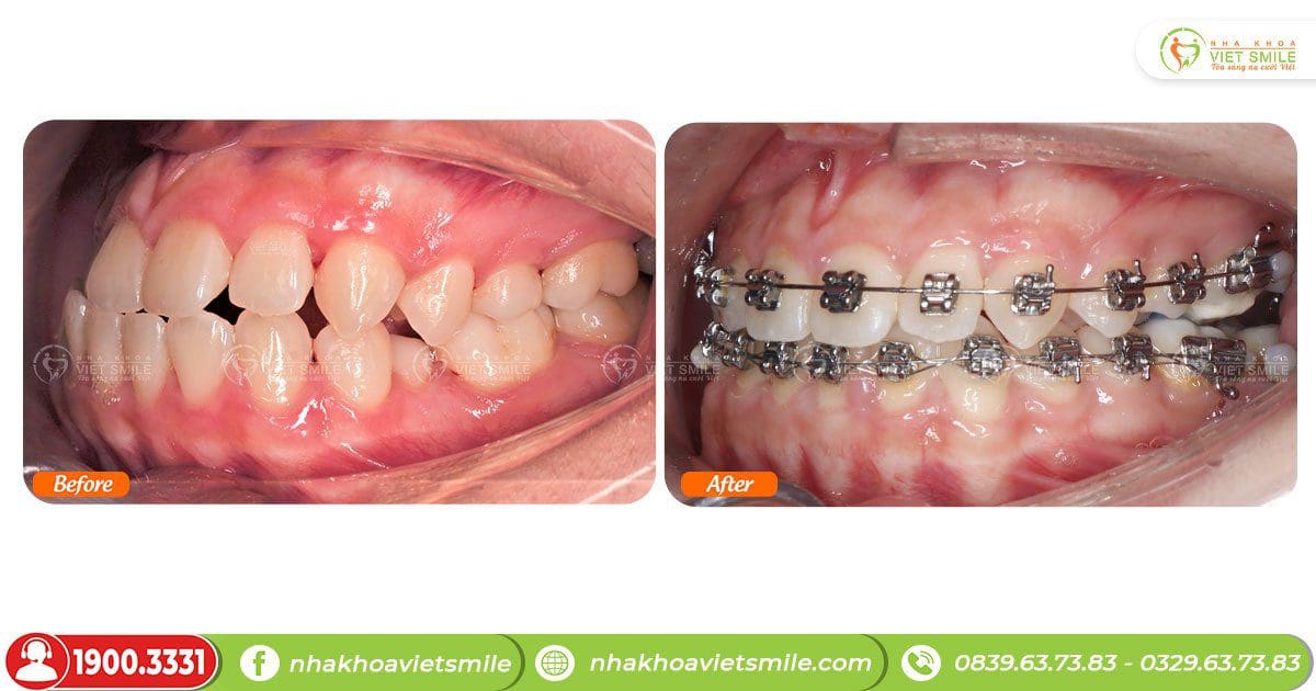 Niềng răng cải thiện khớp cắn ngược, cắn đối đầu