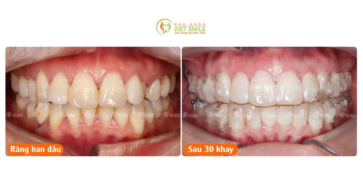 Niềng răng hô, chen chúc với khay trong suốt 