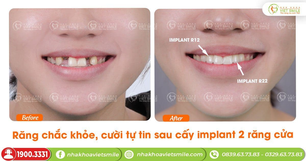 Răng chắc khỏe, cười tự tin sau cấy implant 2 răng cửa