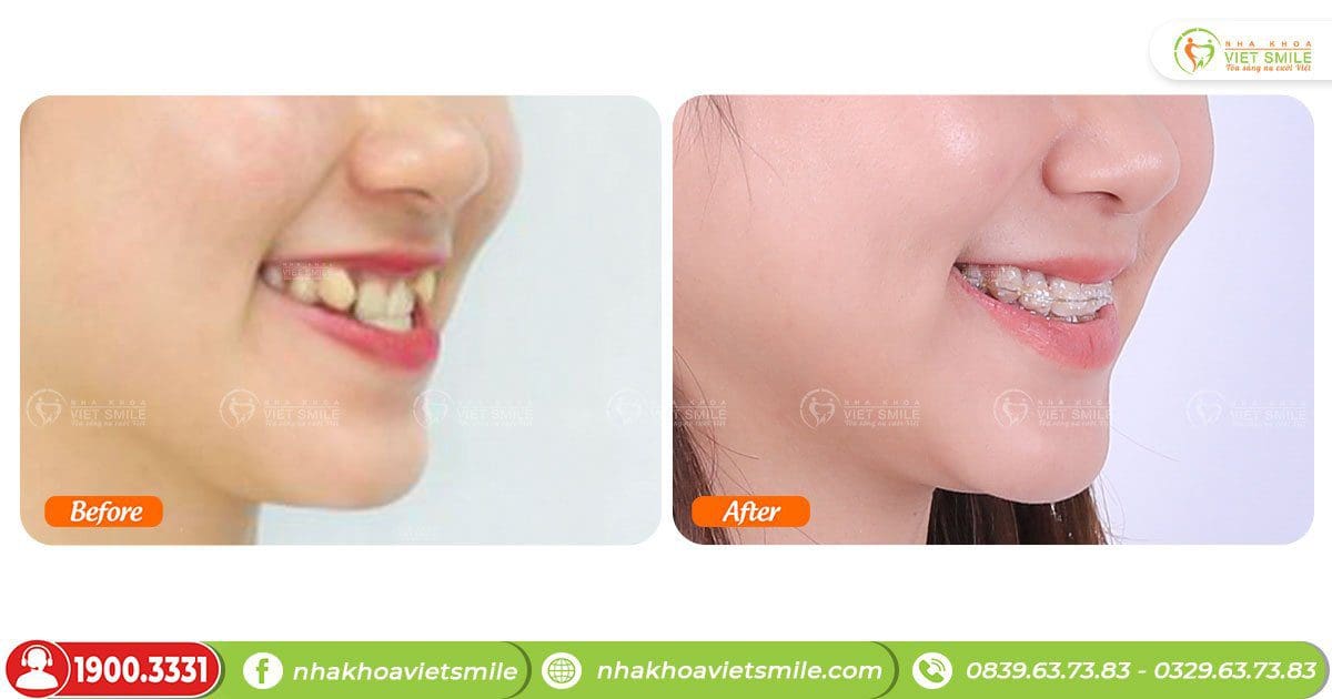 Niềng răng giảm móm, chen chúc, nụ cười tự tin