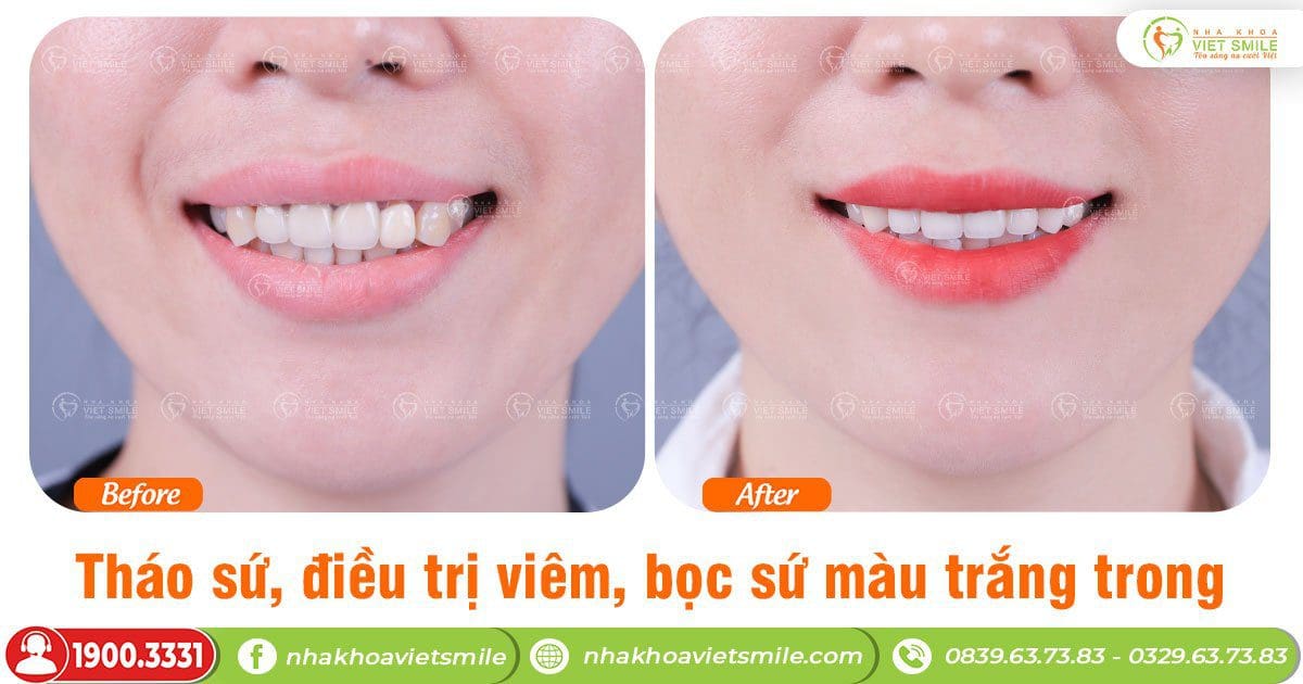 Thẩm mỹ răng sứ giải cứu sứ hỏng