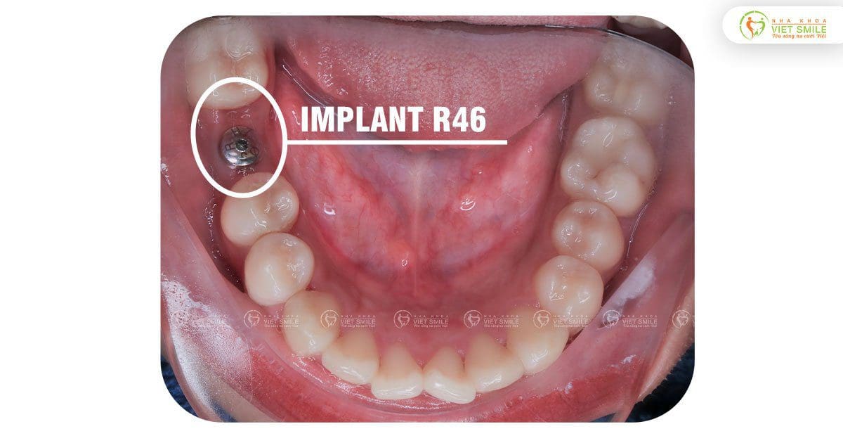 Trồng răng implant răng hàm