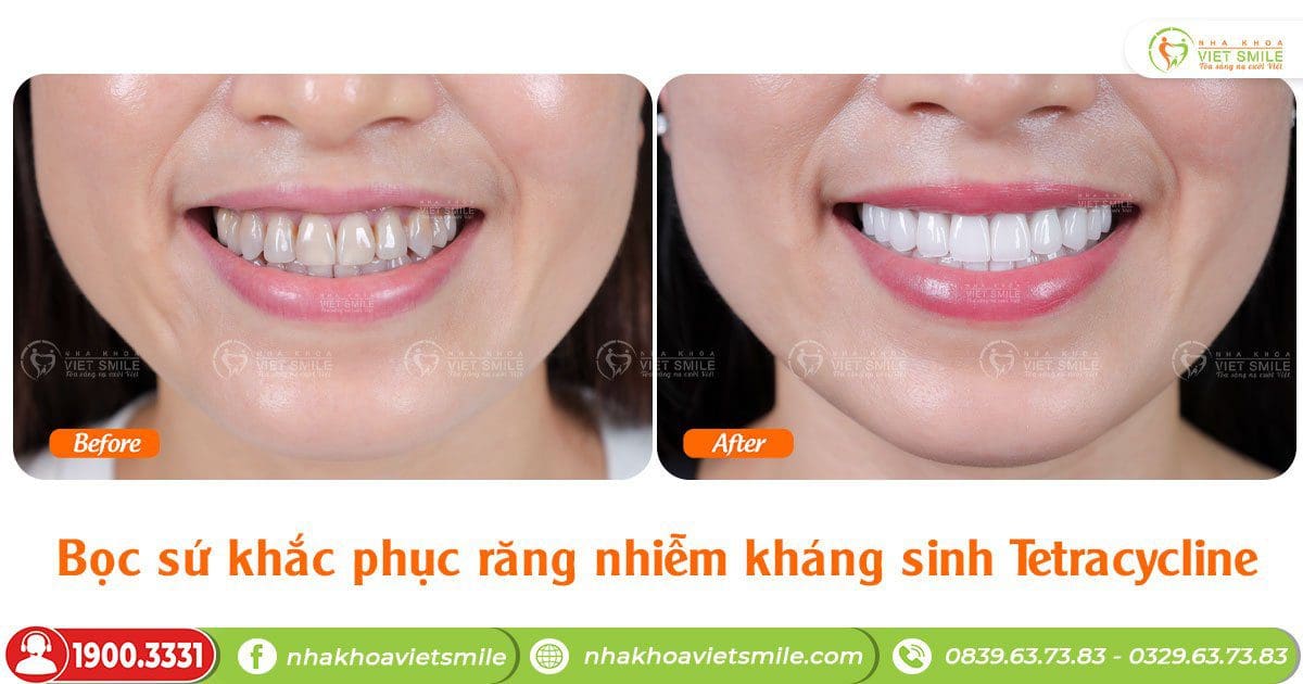 Bọc sứ răng trắng trong, khắc phục răng nhiễm kháng sinh