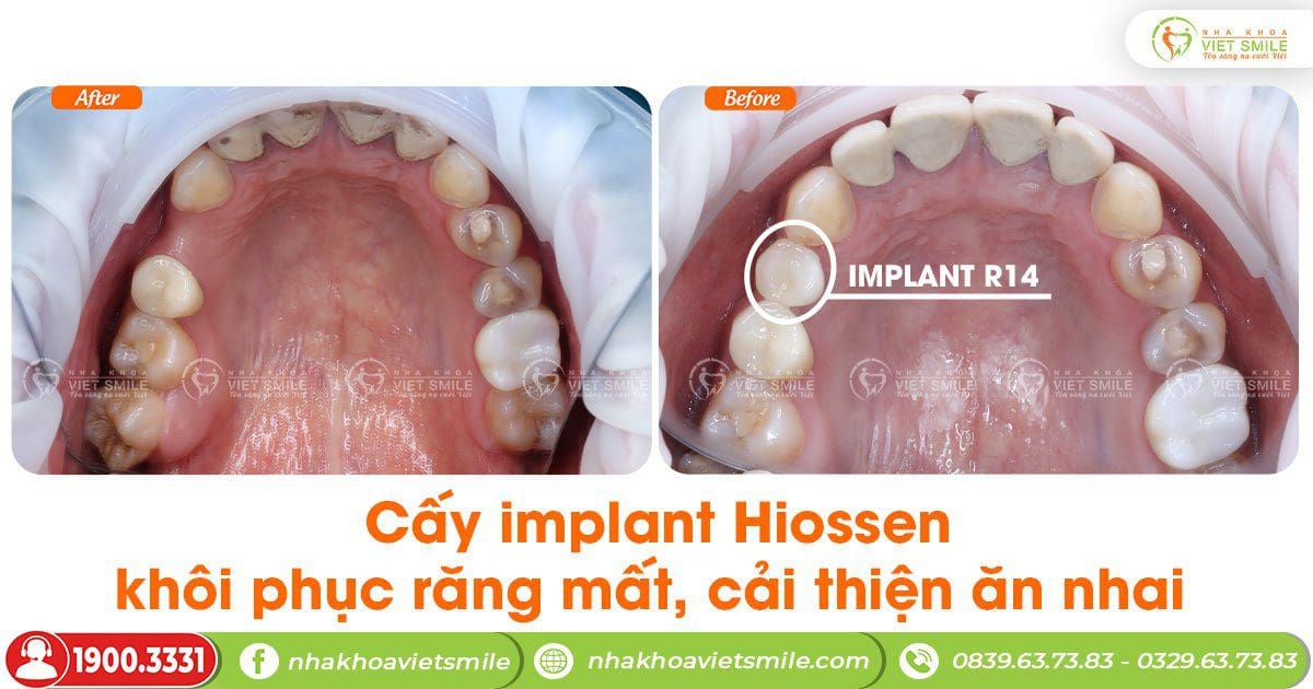 Cấy implant Hiossen khôi phục răng mất cải thiện ăn nhai