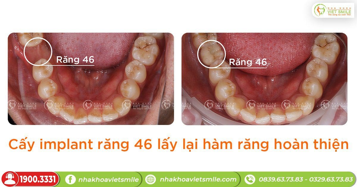 Cấy implant răng 46 lấy lại hàm răng hoàn thiện