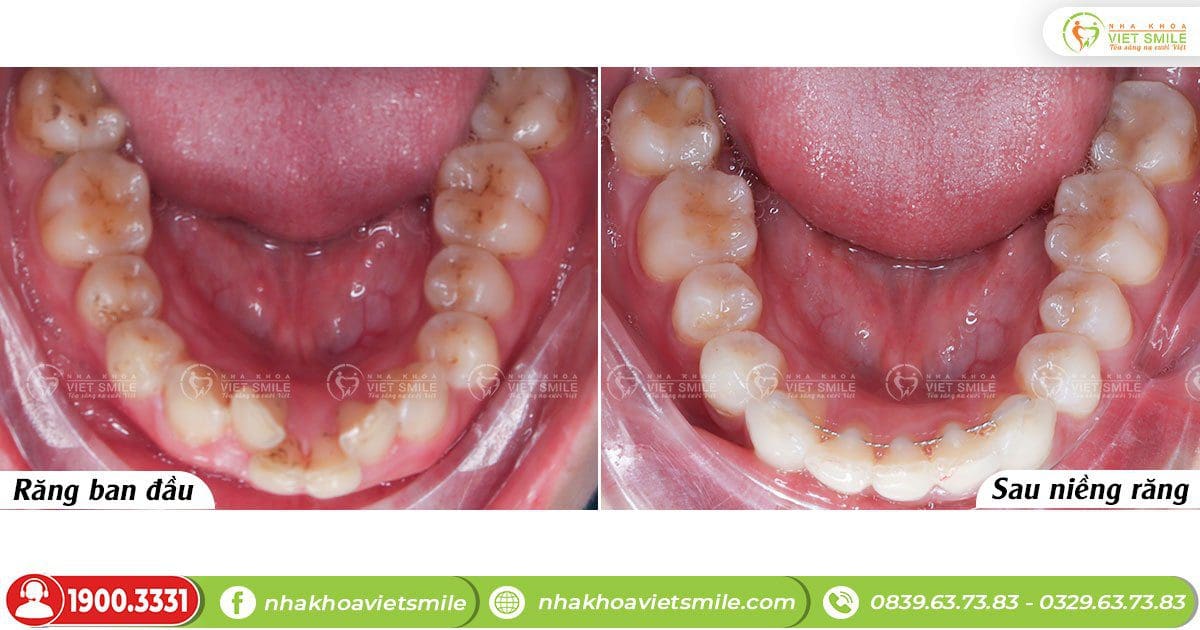 Cung răng hàm dưới hết chen chúc sau niềng răng