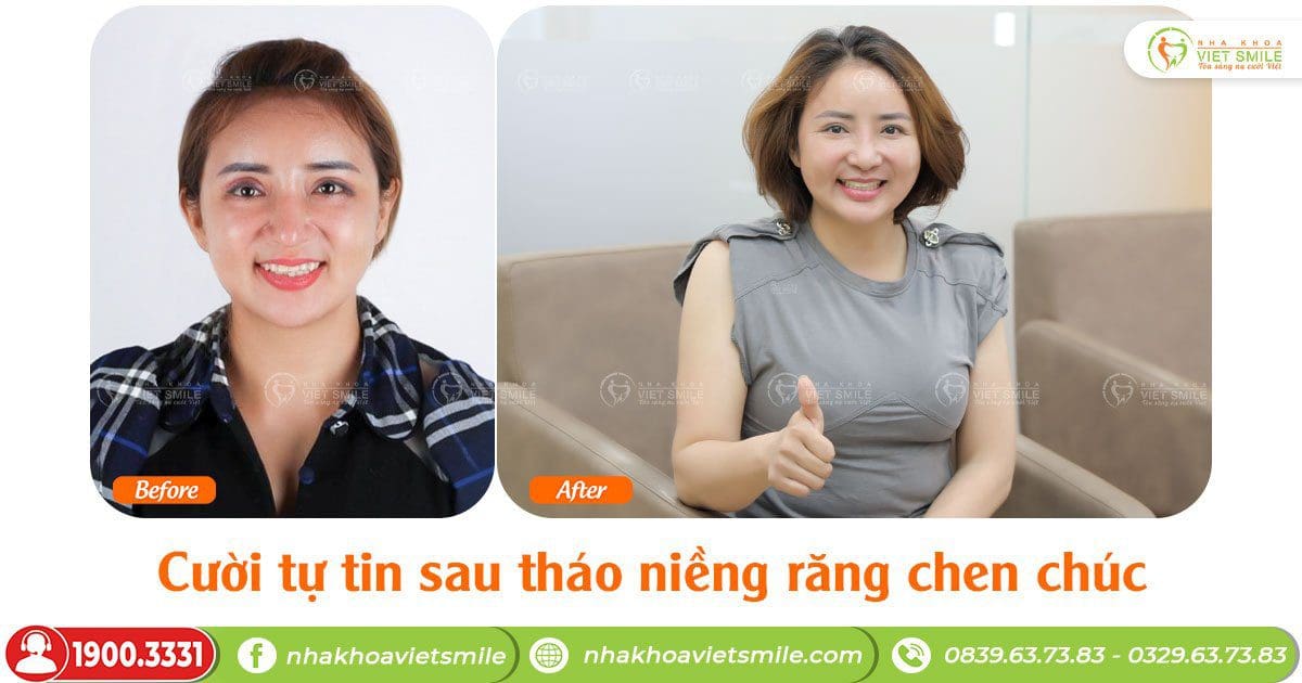 Cười tự tin sau tháo niềng răng chen chúc