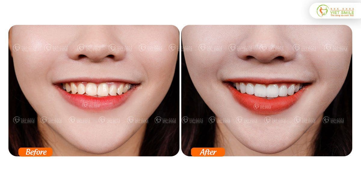 Dán sứ veneer 6 răng cửa thay đổi dáng răng, hoàn thiện nụ cười – KH. Bùi Thị Thanh Xuân CG4848