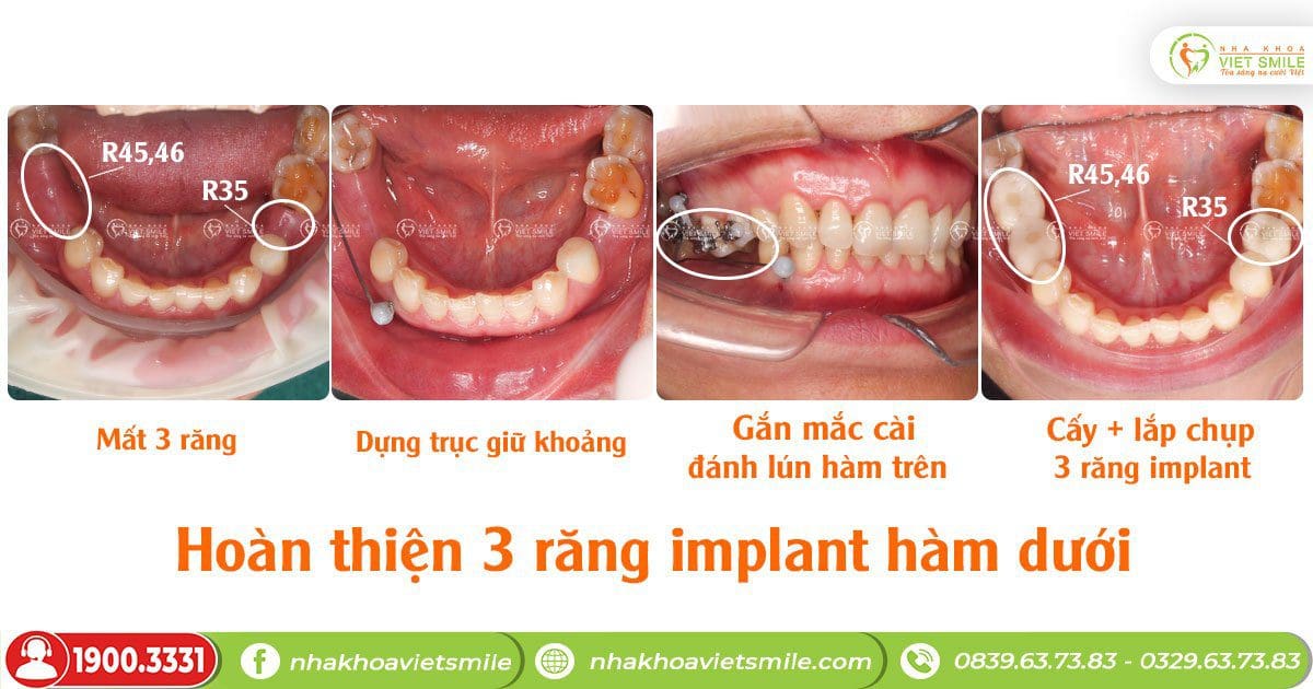 Hoàn thiện quá trình trồng 3 răng implant