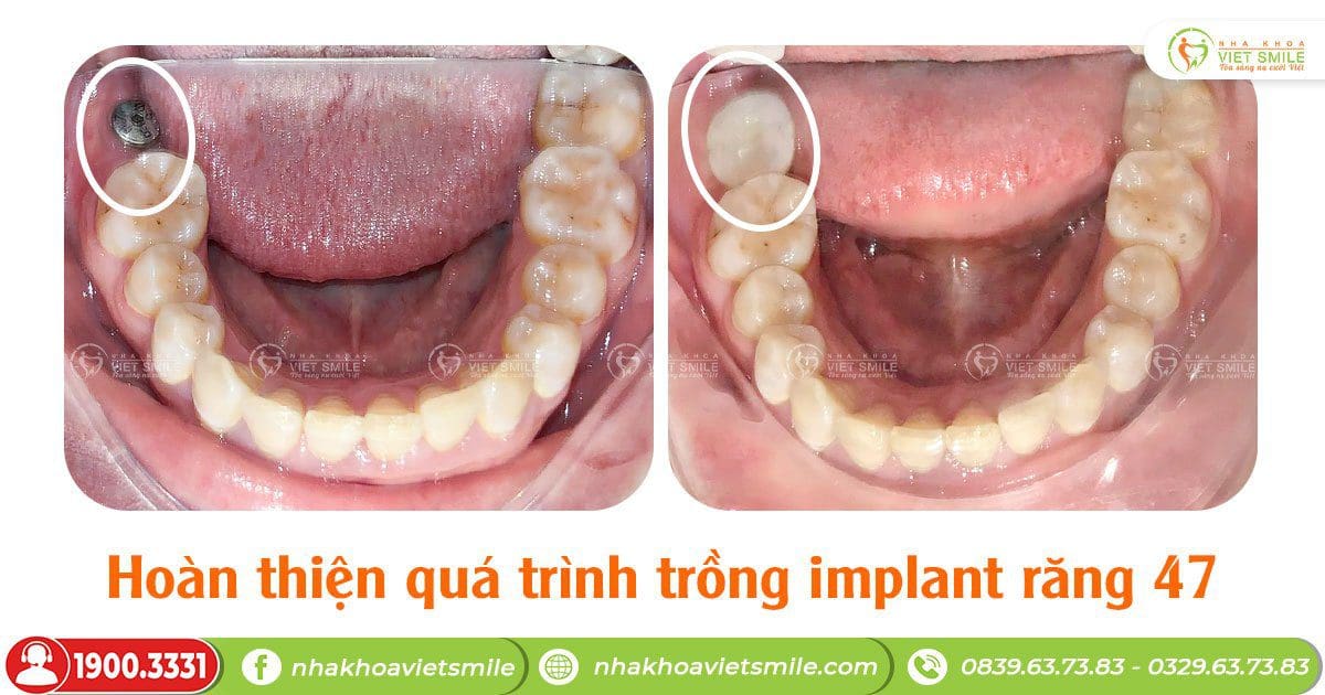 Hoàn thiện quá trình trồng răng implant 47, thoải mái ăn nhai 