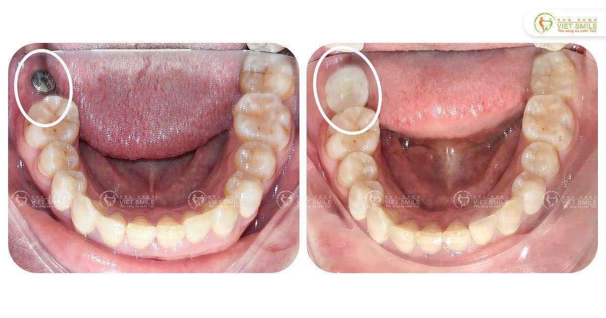 Hoàn thiện quá trình trồng implant răng 47, thoải mái ăn nhai