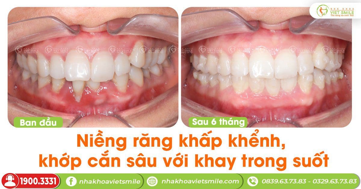 Cải thiện hàm răng khấp khểnh với khay niềng trong suốt