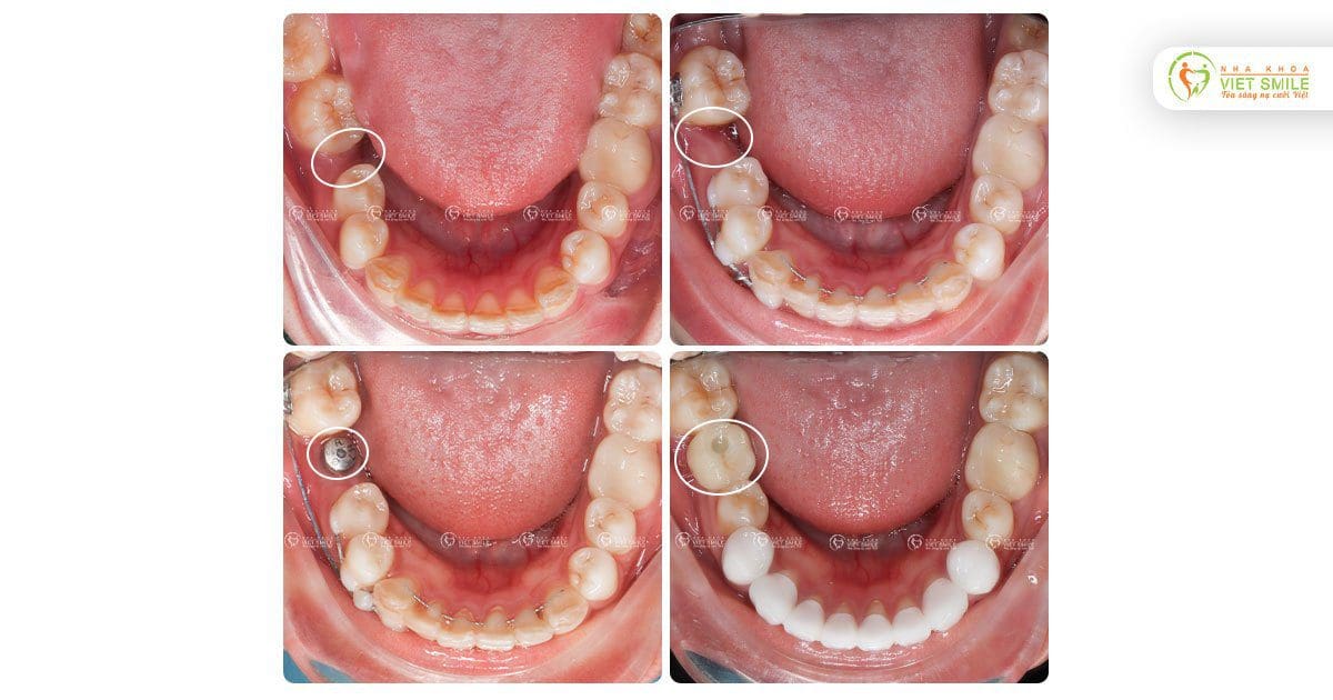 Niềng răng tạo khoảng cấy ghép implant Hiossen răng 46 đã mất