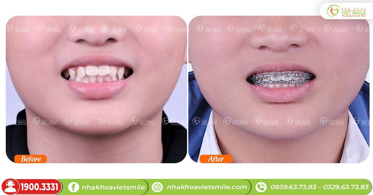 Răng đều đặn, giảm hô sau 20 tháng niềng răng