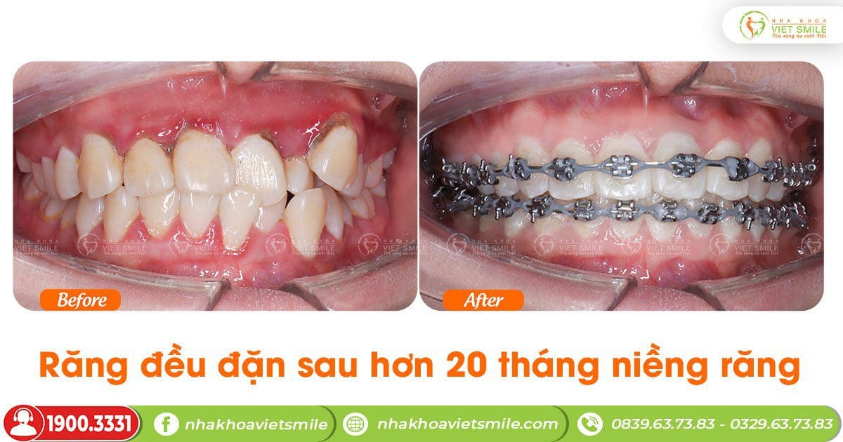Răng đều đặn sau hơn 20 tháng niềng răng