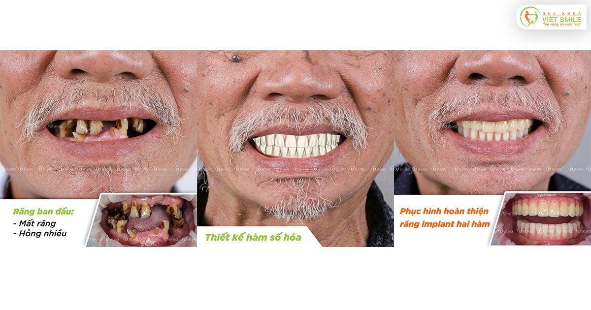 Trồng răng implant phục hình răng hai hàm