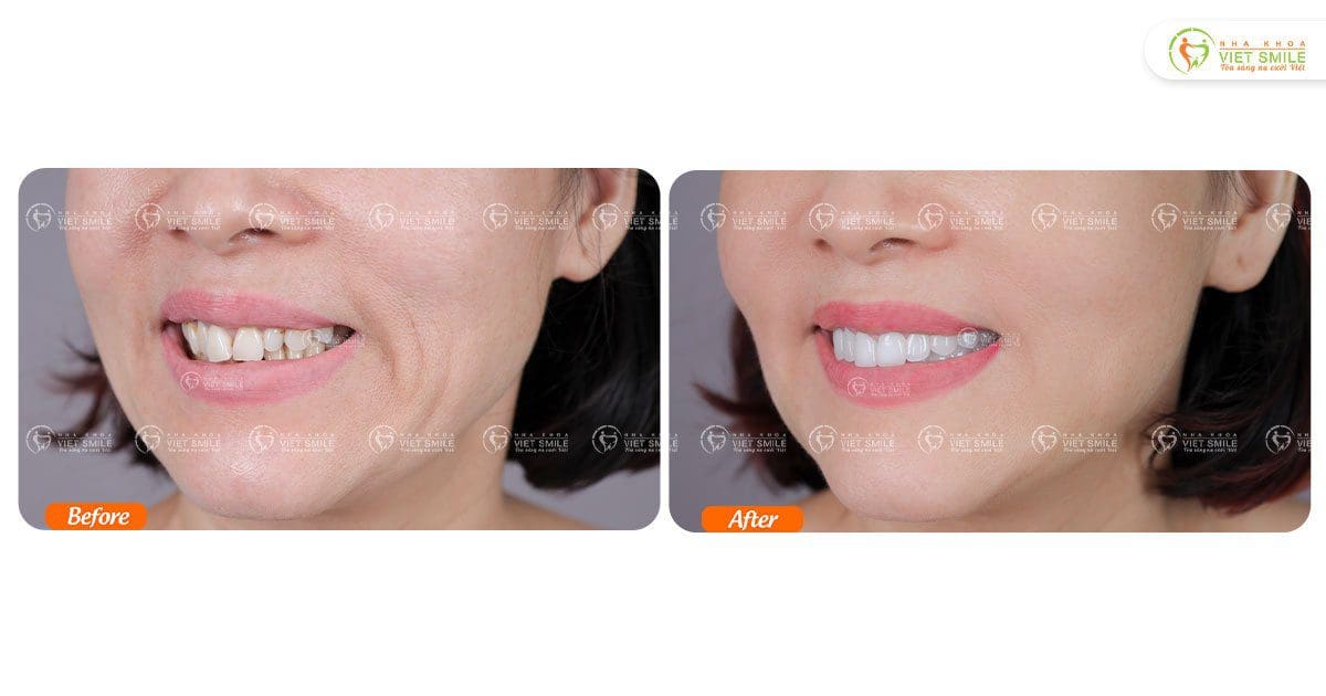 Bọc răng sứ thay đổi hình thể, màu sắc răng – KH Dương Thị Hồng Phúc S5812