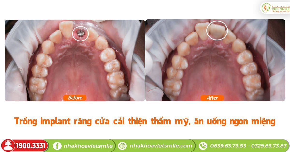 Trồng implant răng cửa cải thiện thẩm mỹ, ăn uống ngon miệng