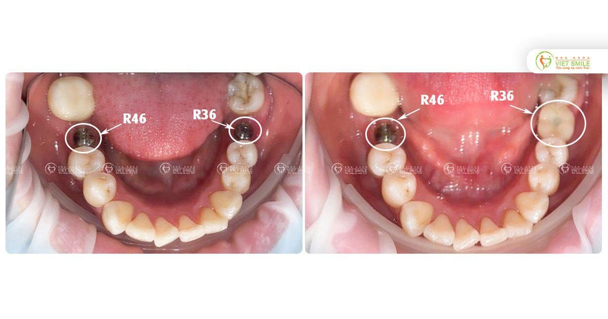 Cấy implant răng 36,46 - Hoàn thiện răng implant 36