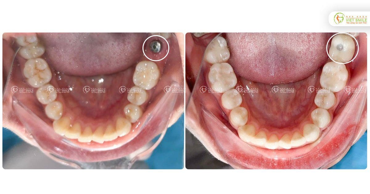 Hoàn thiện quá trình trồng răng implant 37