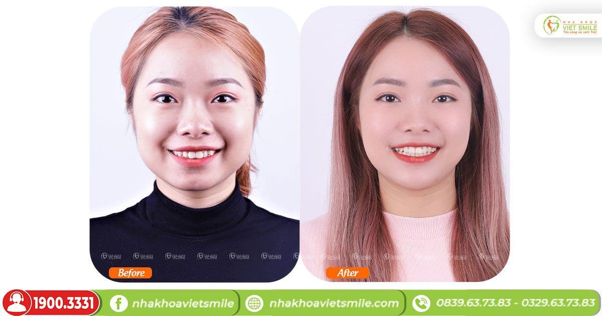 Chi phí niềng răng tại Nha khoa Việt Smile