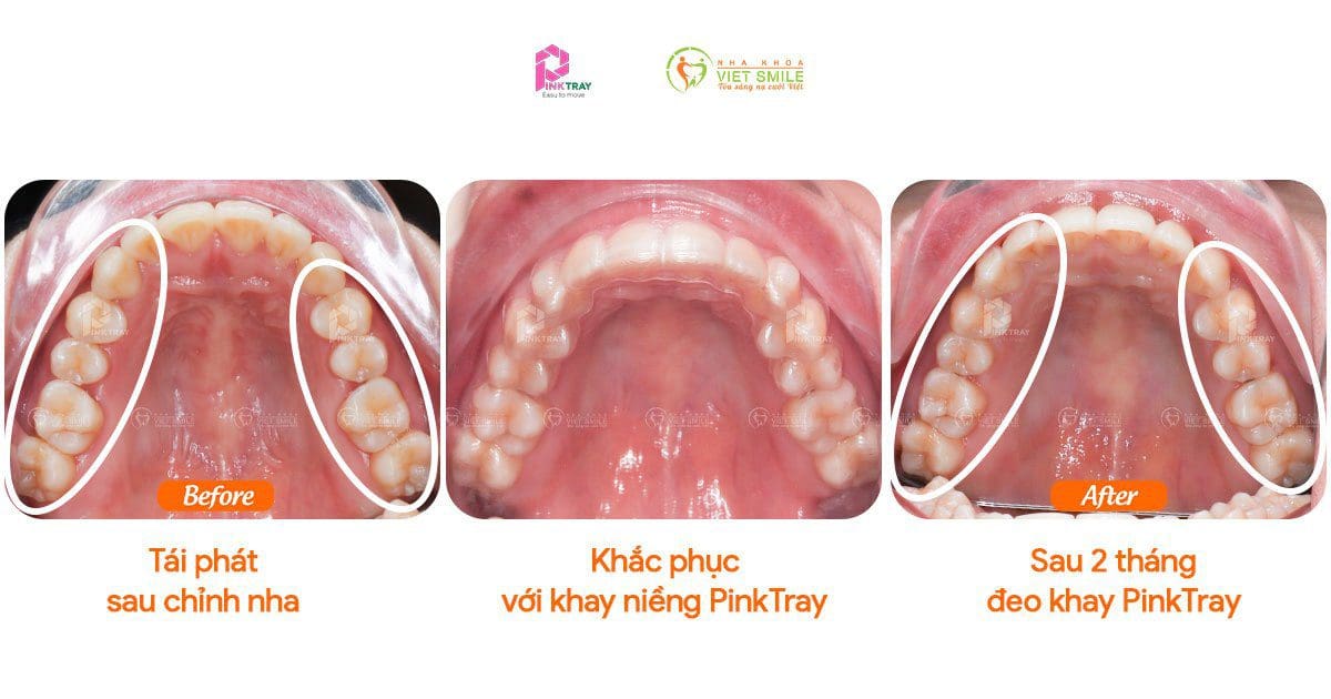 Niềng răng trong suốt PinkTray cải thiện khớp cắn
