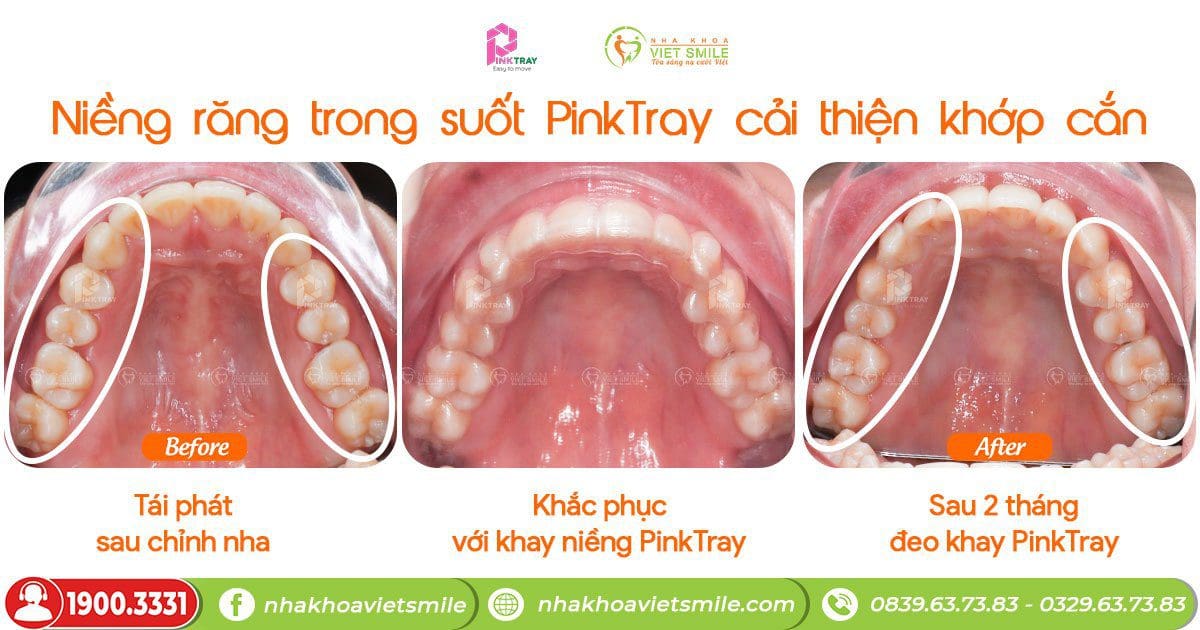 Niềng răng trong suốt PinkTray - khắc phục tình trạng tái phát sau chỉnh nha