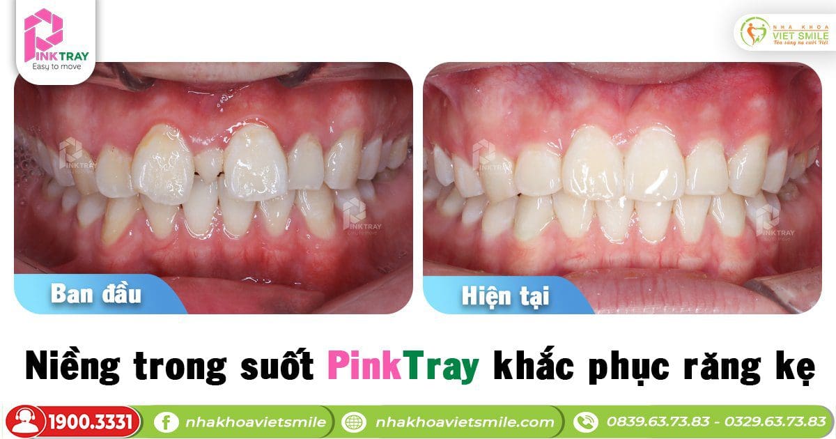 Niềng trong suốt pinktray khắc phục răng kẹ