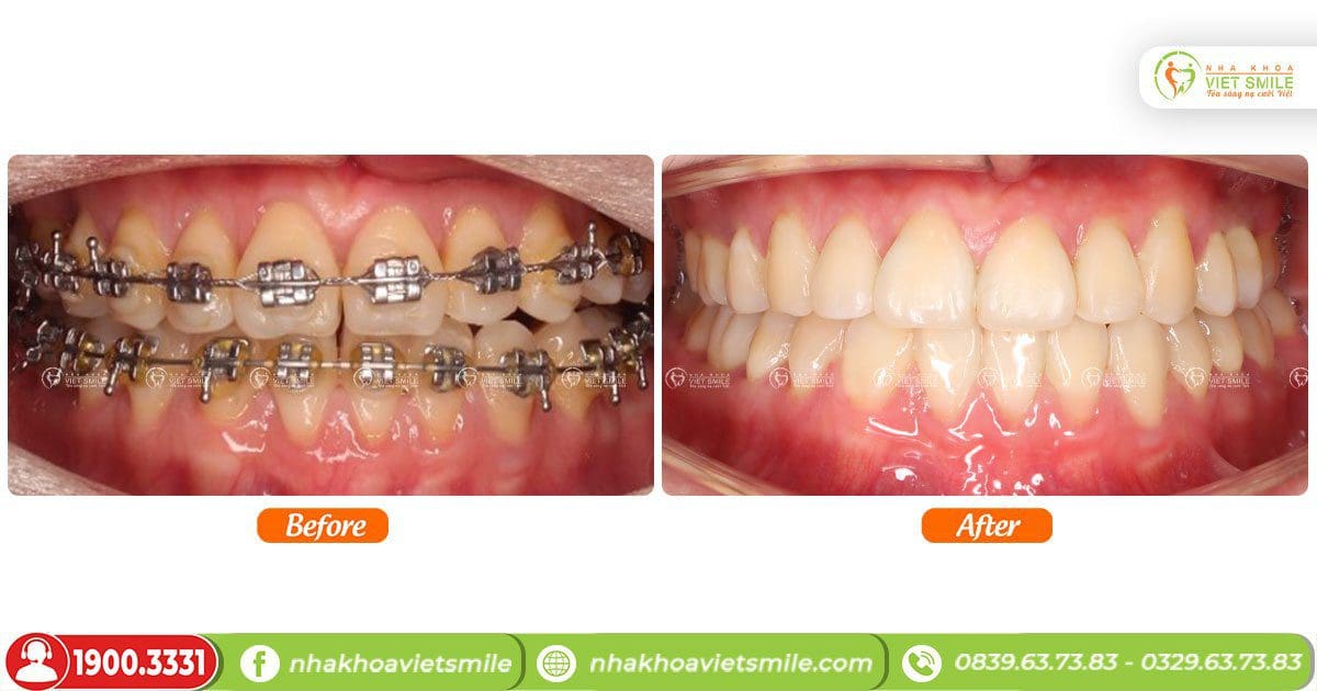 Trước và sau khi niềng răng tại VIET SMILE