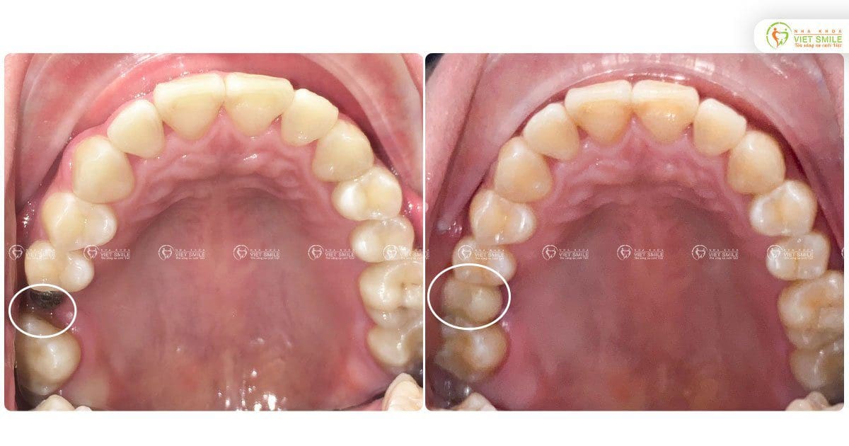 Trồng răng implant 16, cải thiện ăn nhai