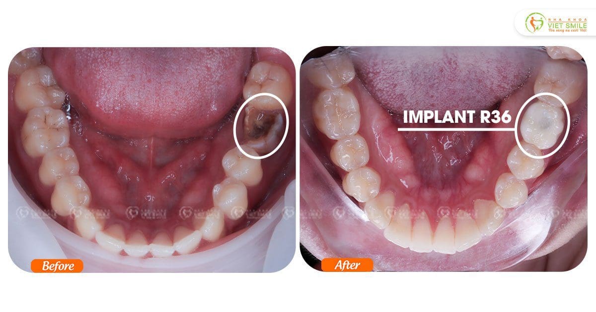Hoàn thiện quá trình trồng răng implant