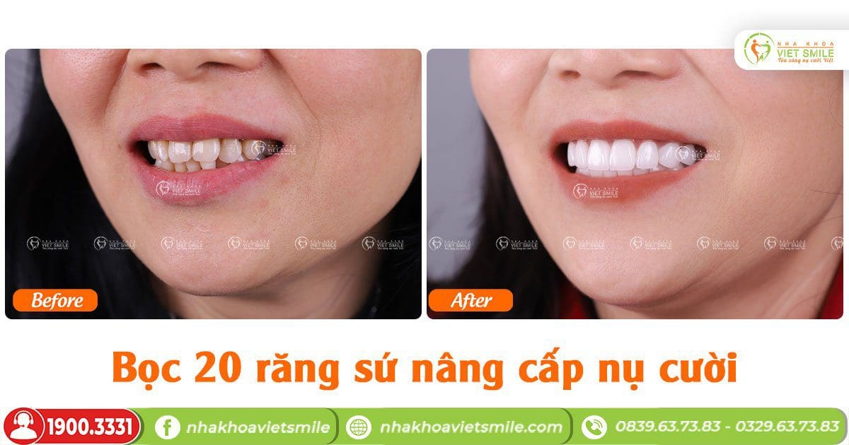 Bọc 20 răng sứ nâng cấp nụ cười 