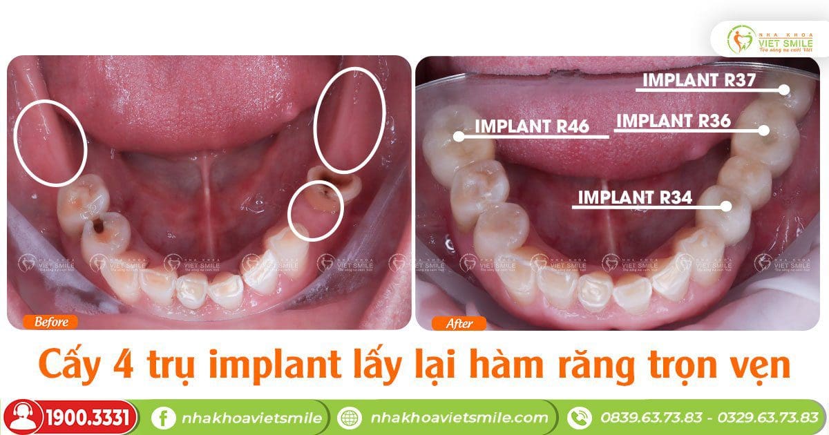 Cấy 4 trụ implant khôi phục hàm răng trọn vẹn