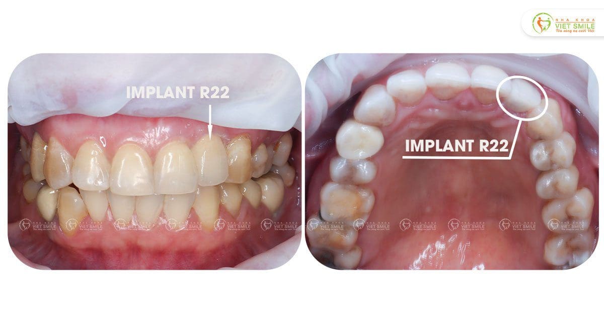 Phục hình implant R22 tự nhiên như răng thật – KH Nguyễn Thị Vợi HN8426