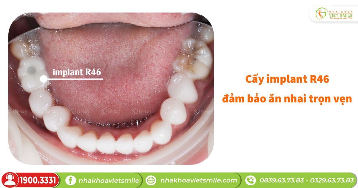 Cấy implant răng 46 đảm bảo ăn nhai trọn vẹn