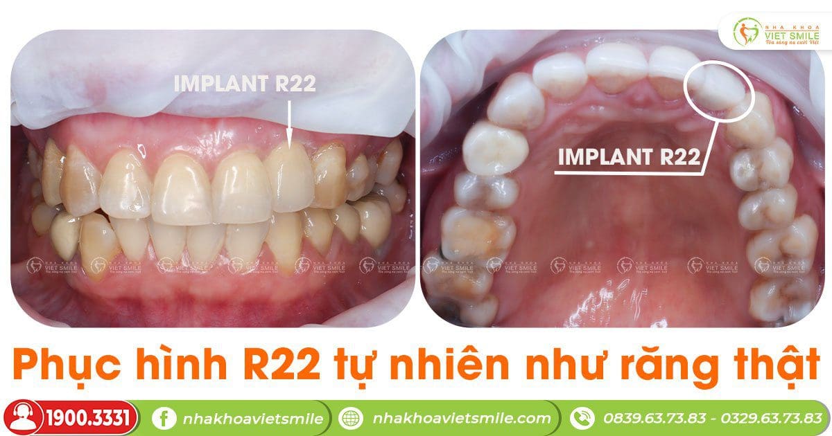 Phục hình implant R22 tự nhiên như răng thật