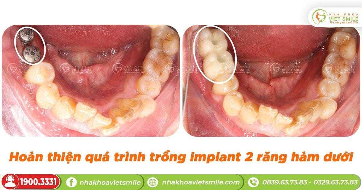 Hoàn thiện 2 răng implant, đảm bảo ăn nhai