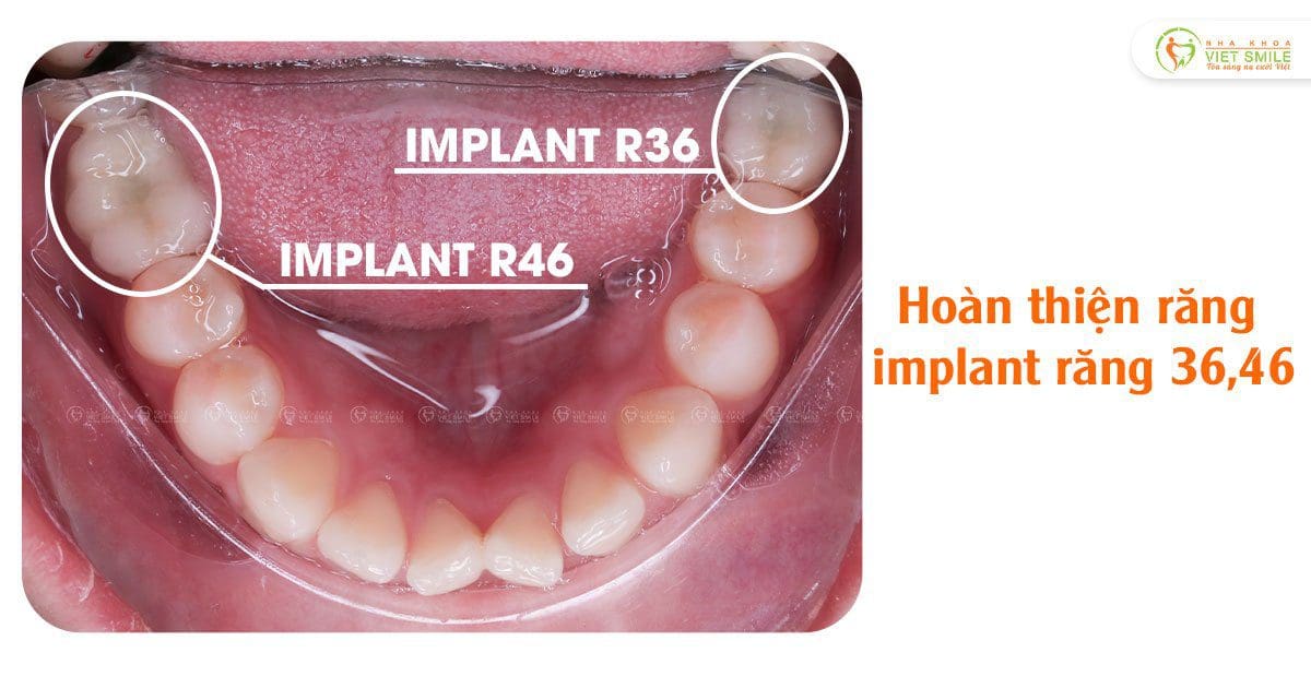 Cấy ghép implant lấy lại cảm giác ăn nhai cho 2 răng số 6