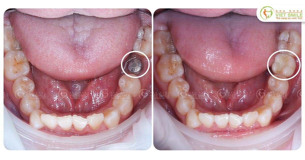 Cấy ghép implant khôi phục răng 6