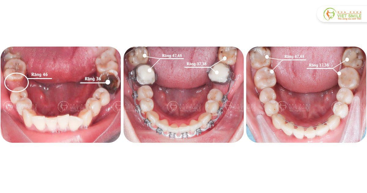 Niềng răng dựng trục, kéo răng 7,8 thay thế răng 6 mất, sâu hỏng – KH L.T Thu Hiền 3059
