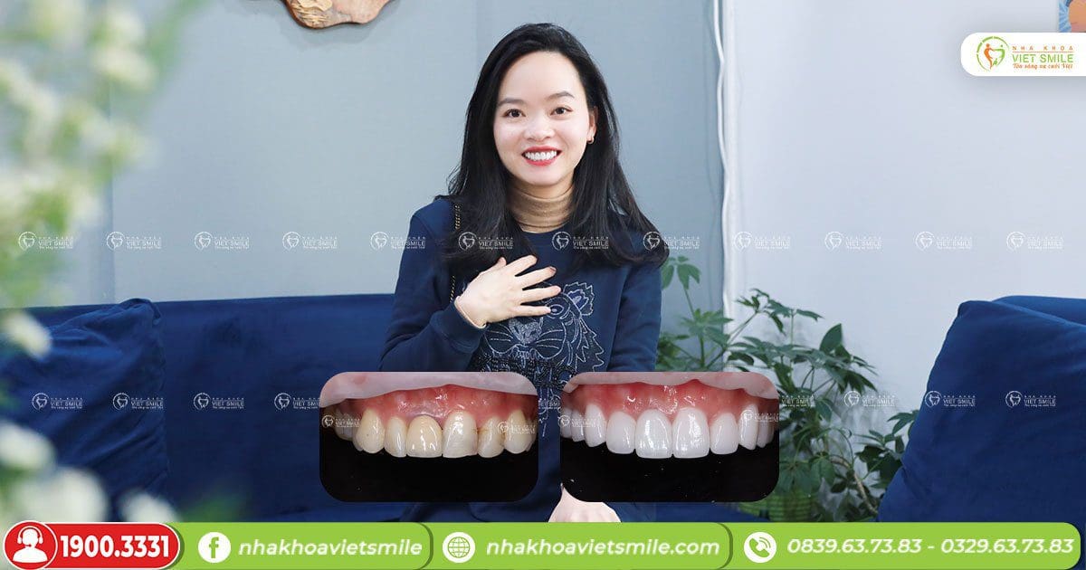 Thay đổi ngoạn mục khi làm răng sứ tại VIET SMILE